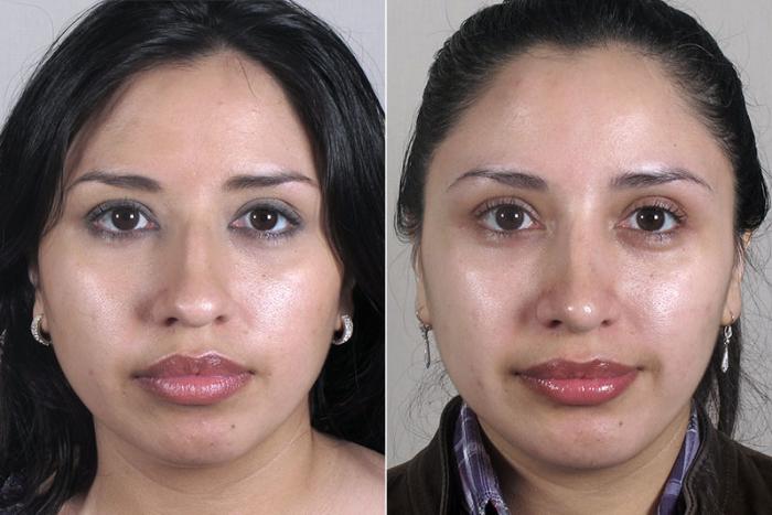 Rhinoplasty Case 165 Before & After View #1 | Paramus, New Jersey | Parker Center for Plastic Surgery