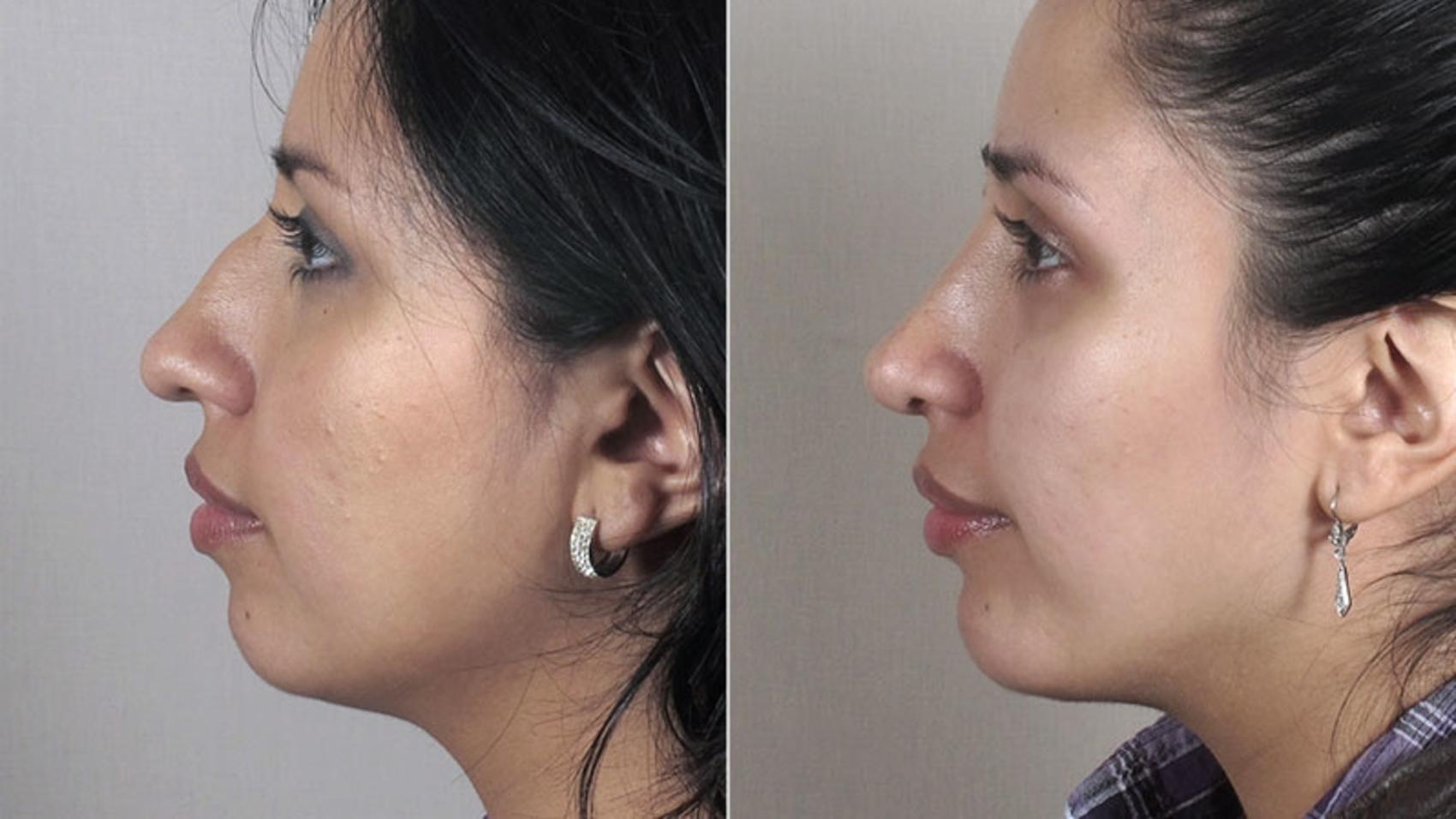 Rhinoplasty Case 165 Before & After View #2 | Paramus, New Jersey | Parker Center for Plastic Surgery