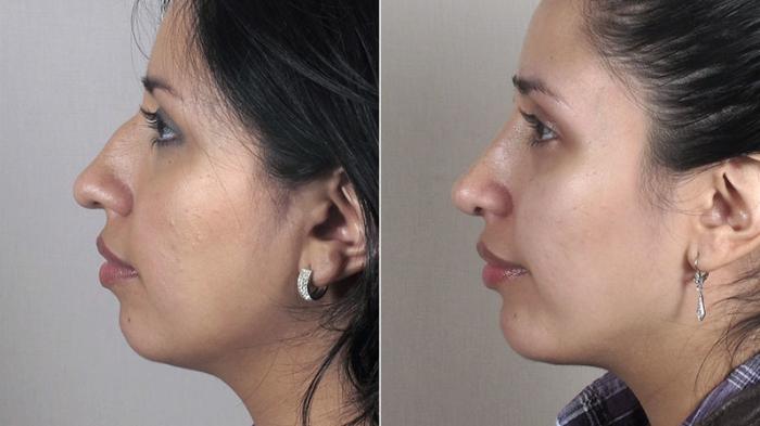Rhinoplasty Case 165 Before & After View #2 | Paramus, New Jersey | Parker Center for Plastic Surgery