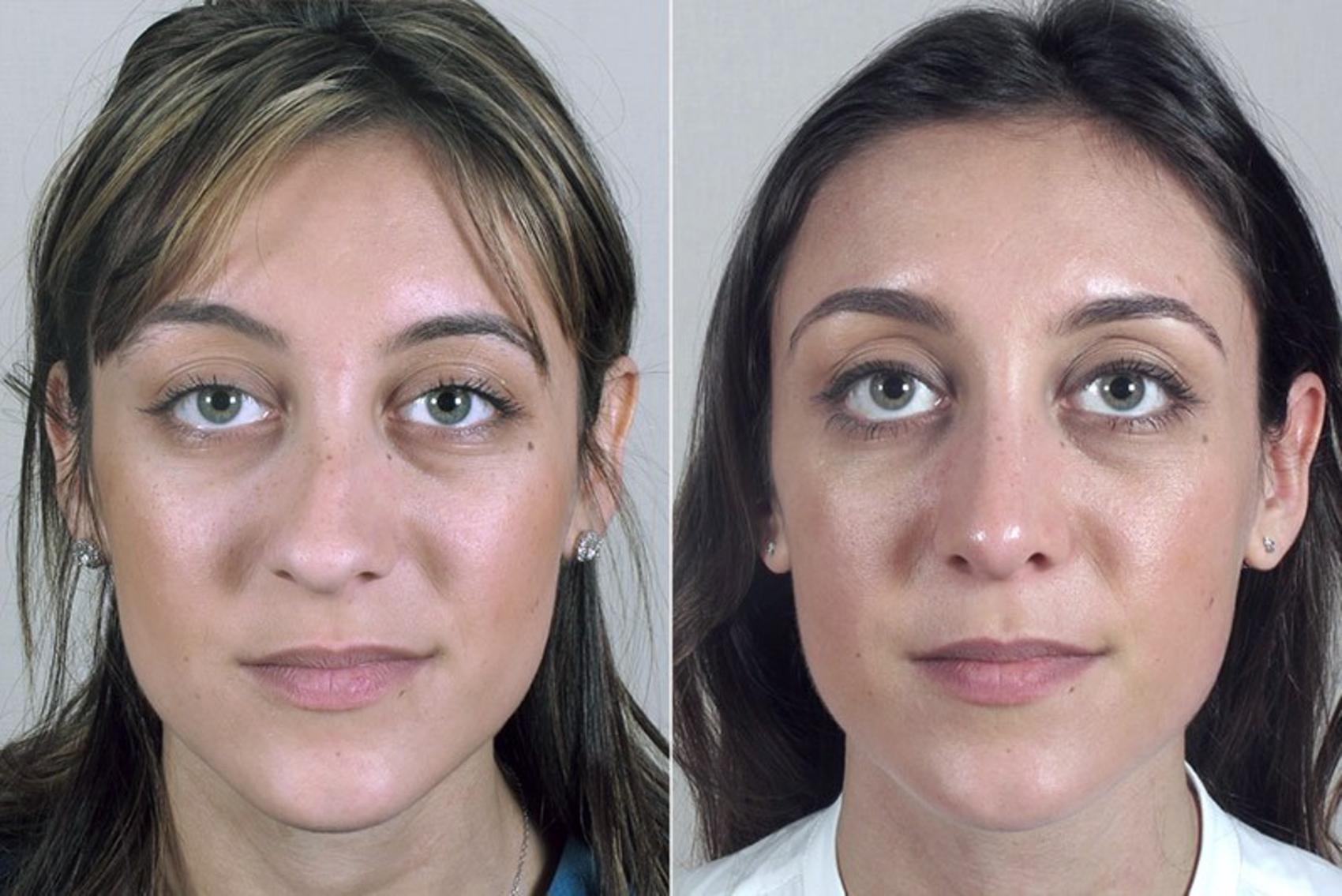 Rhinoplasty Case 166 Before & After View #1 | Paramus, New Jersey | Parker Center for Plastic Surgery