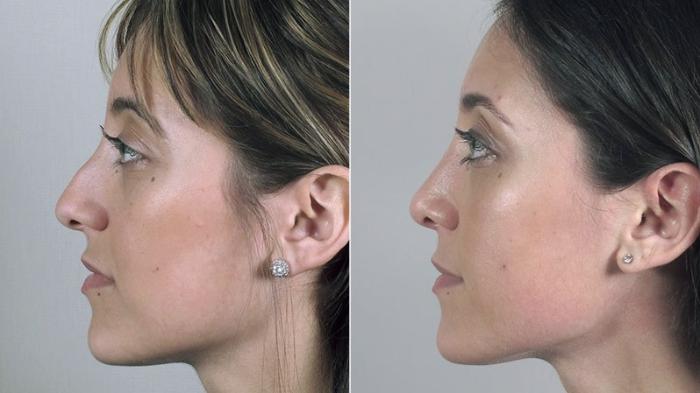 Rhinoplasty Case 166 Before & After View #2 | Paramus, New Jersey | Parker Center for Plastic Surgery