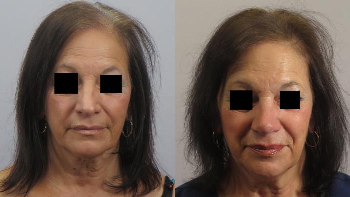 Rhinoplasty Case 1662 Before & After Front | Paramus, New Jersey | Parker Center for Plastic Surgery