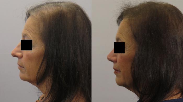 Rhinoplasty Case 1662 Before & After Left Side | Paramus, New Jersey | Parker Center for Plastic Surgery