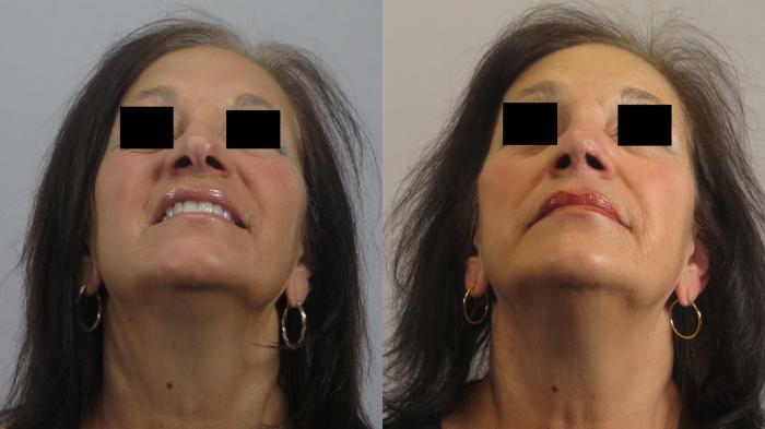 Rhinoplasty Case 1662 Before & After worms | Paramus, New Jersey | Parker Center for Plastic Surgery