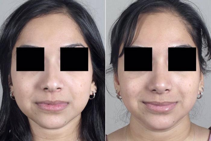 Rhinoplasty Case 167 Before & After View #1 | Paramus, New Jersey | Parker Center for Plastic Surgery