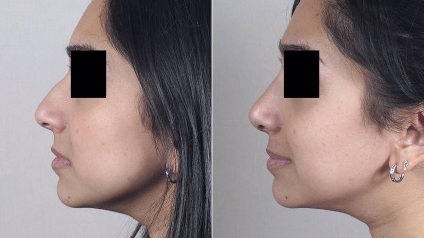 Rhinoplasty Case 167 Before & After View #2 | Paramus, New Jersey | Parker Center for Plastic Surgery