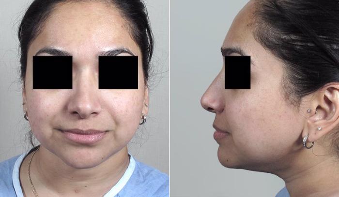 Rhinoplasty Case 167 Before & After View #3 | Paramus, New Jersey | Parker Center for Plastic Surgery