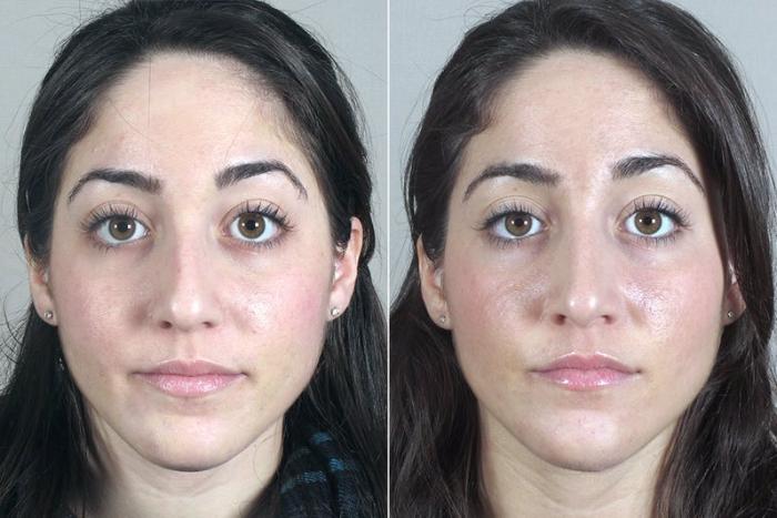 Rhinoplasty Case 168 Before & After View #1 | Paramus, New Jersey | Parker Center for Plastic Surgery