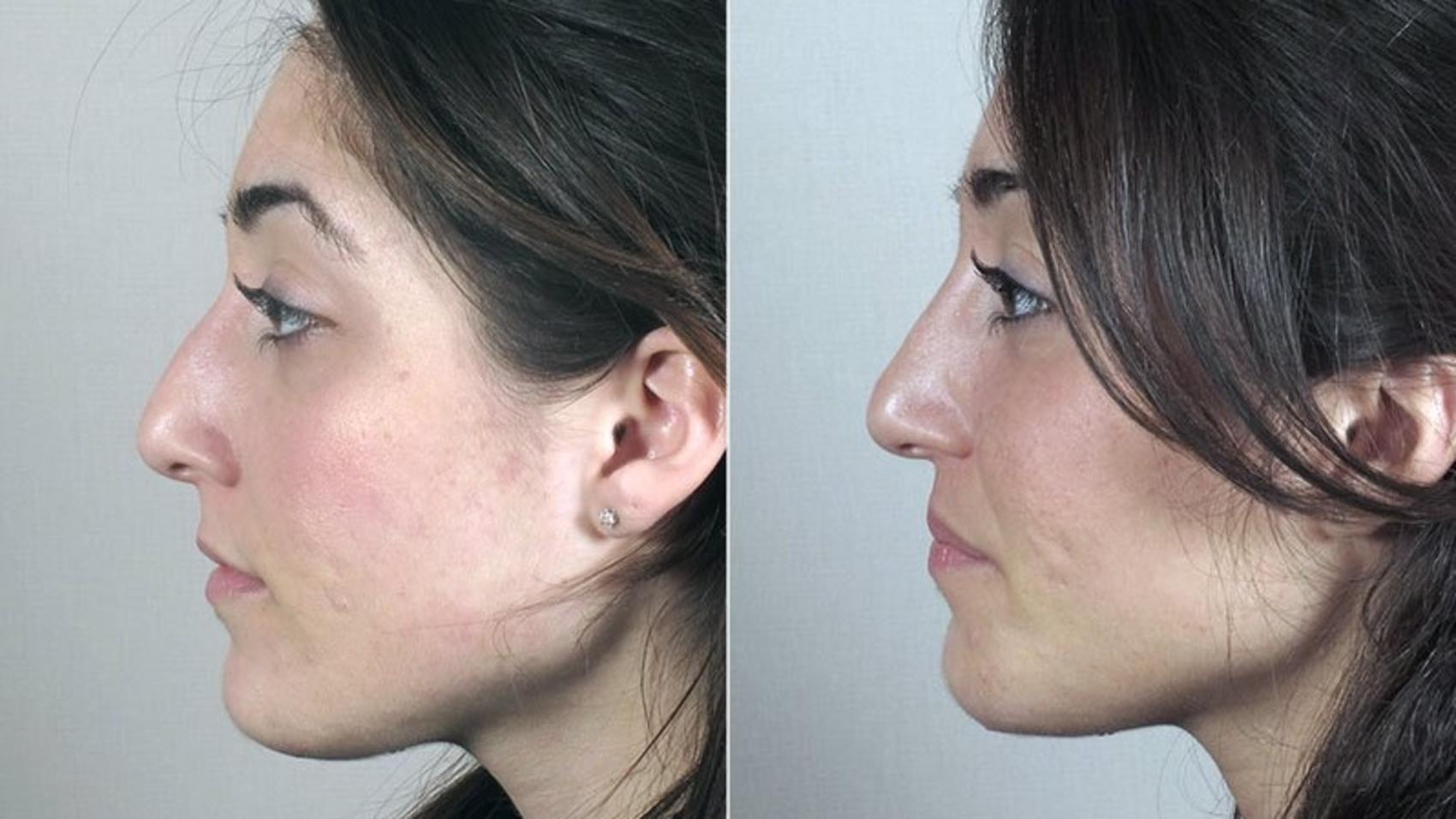 Rhinoplasty Case 168 Before & After View #2 | Paramus, New Jersey | Parker Center for Plastic Surgery
