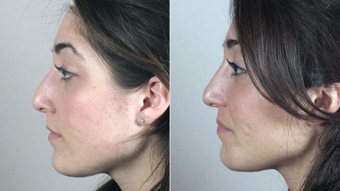 Rhinoplasty Case 168 Before & After View #2 | Paramus, New Jersey | Parker Center for Plastic Surgery