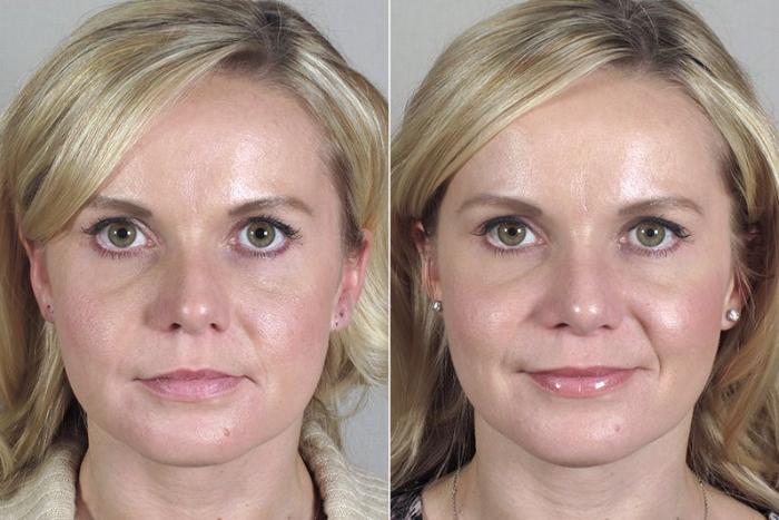 Rhinoplasty Case 169 Before & After View #1 | Paramus, New Jersey | Parker Center for Plastic Surgery