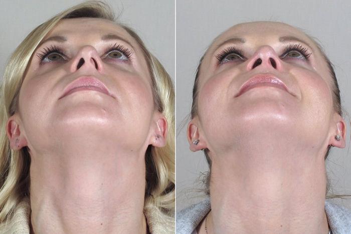Rhinoplasty Case 169 Before & After View #2 | Paramus, New Jersey | Parker Center for Plastic Surgery