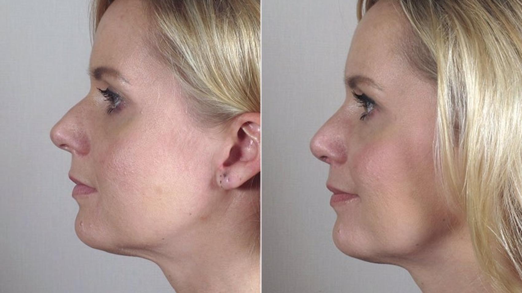 Rhinoplasty Case 169 Before & After View #3 | Paramus, New Jersey | Parker Center for Plastic Surgery