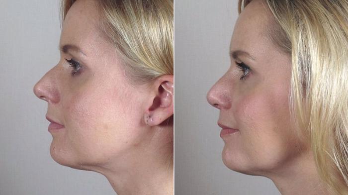 Rhinoplasty Case 169 Before & After View #3 | Paramus, New Jersey | Parker Center for Plastic Surgery