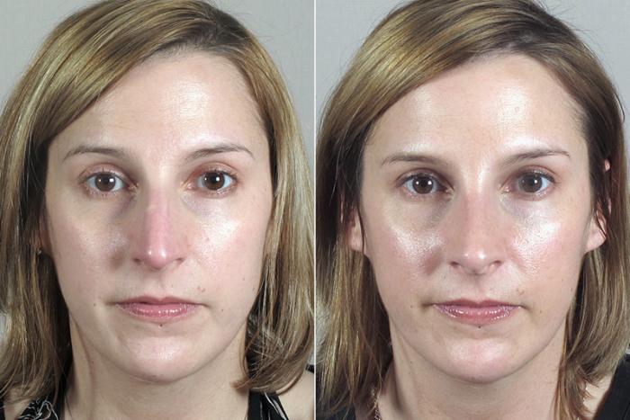 Rhinoplasty Case 170 Before & After View #1 | Paramus, New Jersey | Parker Center for Plastic Surgery