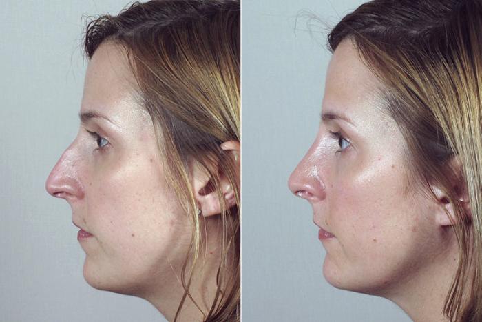 Rhinoplasty Case 170 Before & After View #2 | Paramus, New Jersey | Parker Center for Plastic Surgery