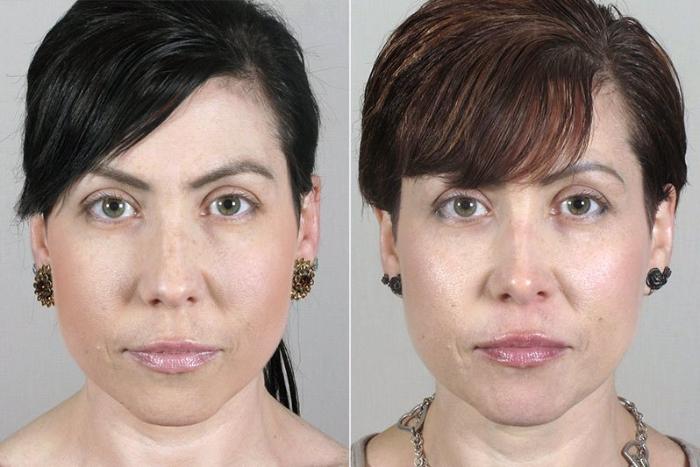 Rhinoplasty Case 171 Before & After View #1 | Paramus, New Jersey | Parker Center for Plastic Surgery