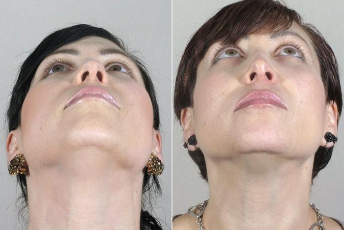 Rhinoplasty Case 171 Before & After View #2 | Paramus, New Jersey | Parker Center for Plastic Surgery