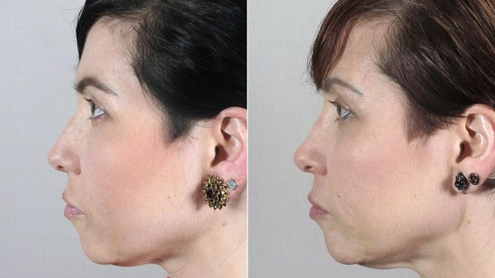 Rhinoplasty Case 171 Before & After View #3 | Paramus, New Jersey | Parker Center for Plastic Surgery