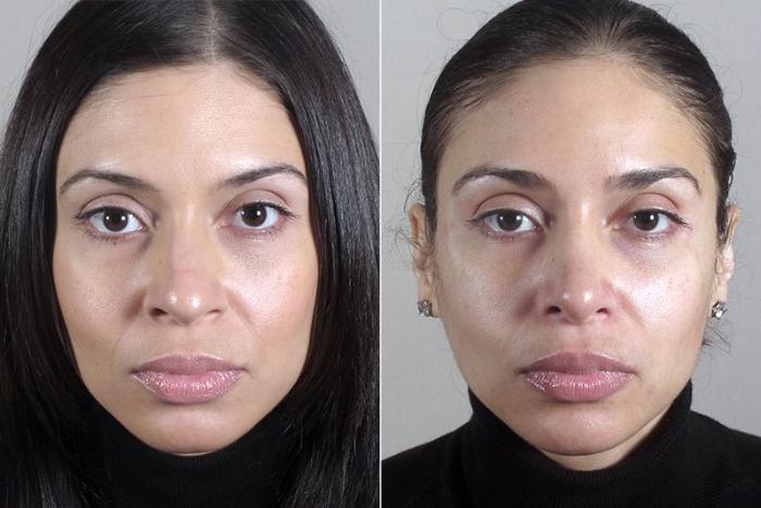 Rhinoplasty Case 172 Before & After View #1 | Paramus, New Jersey | Parker Center for Plastic Surgery