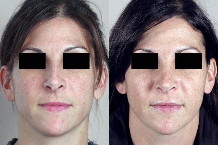 Rhinoplasty Case 173 Before & After View #1 | Paramus, New Jersey | Parker Center for Plastic Surgery