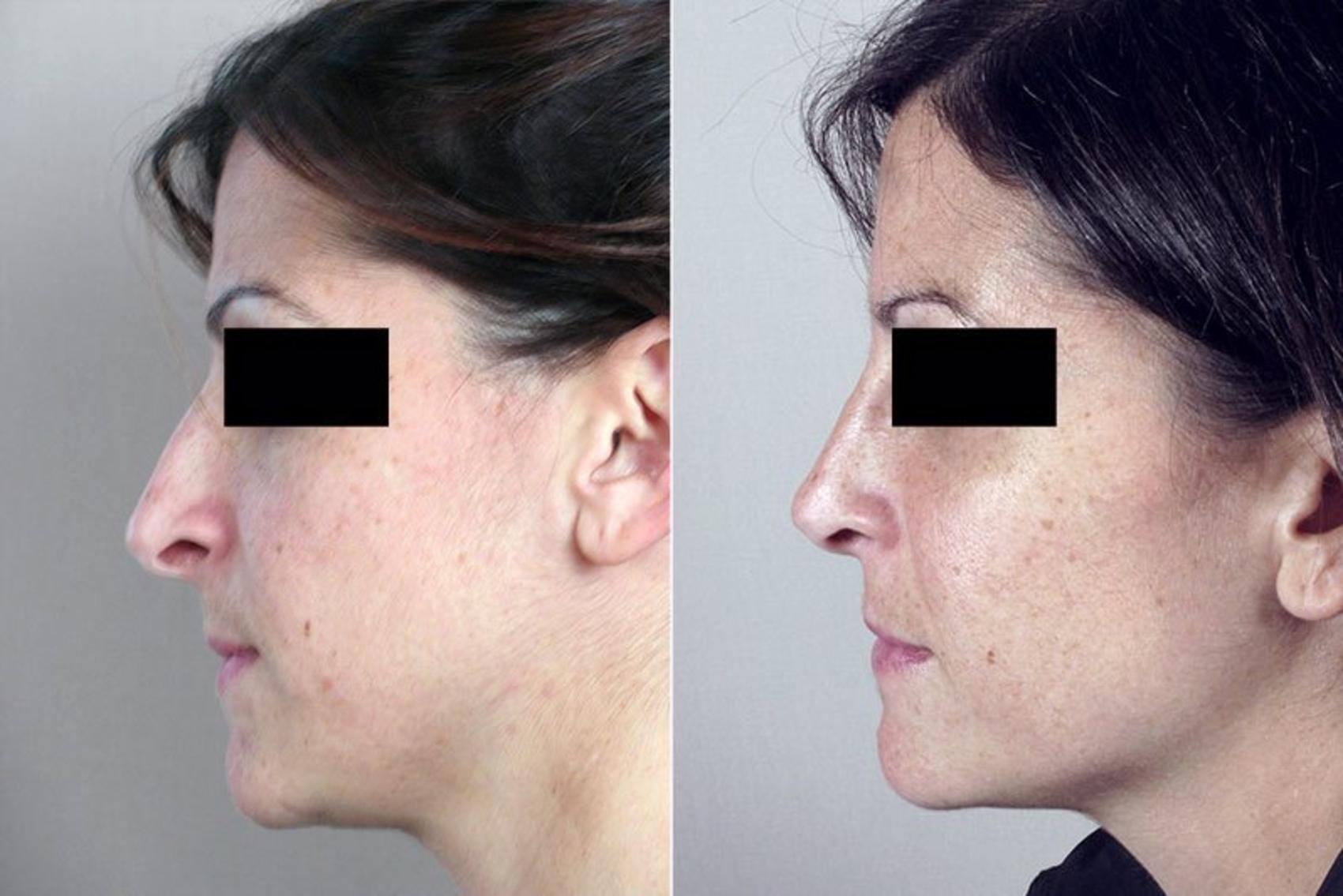 Rhinoplasty Case 173 Before & After View #2 | Paramus, New Jersey | Parker Center for Plastic Surgery