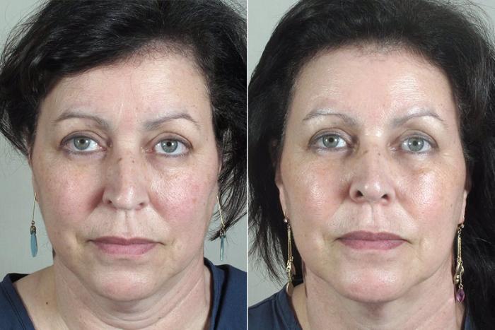 Rhinoplasty Case 174 Before & After View #1 | Paramus, New Jersey | Parker Center for Plastic Surgery
