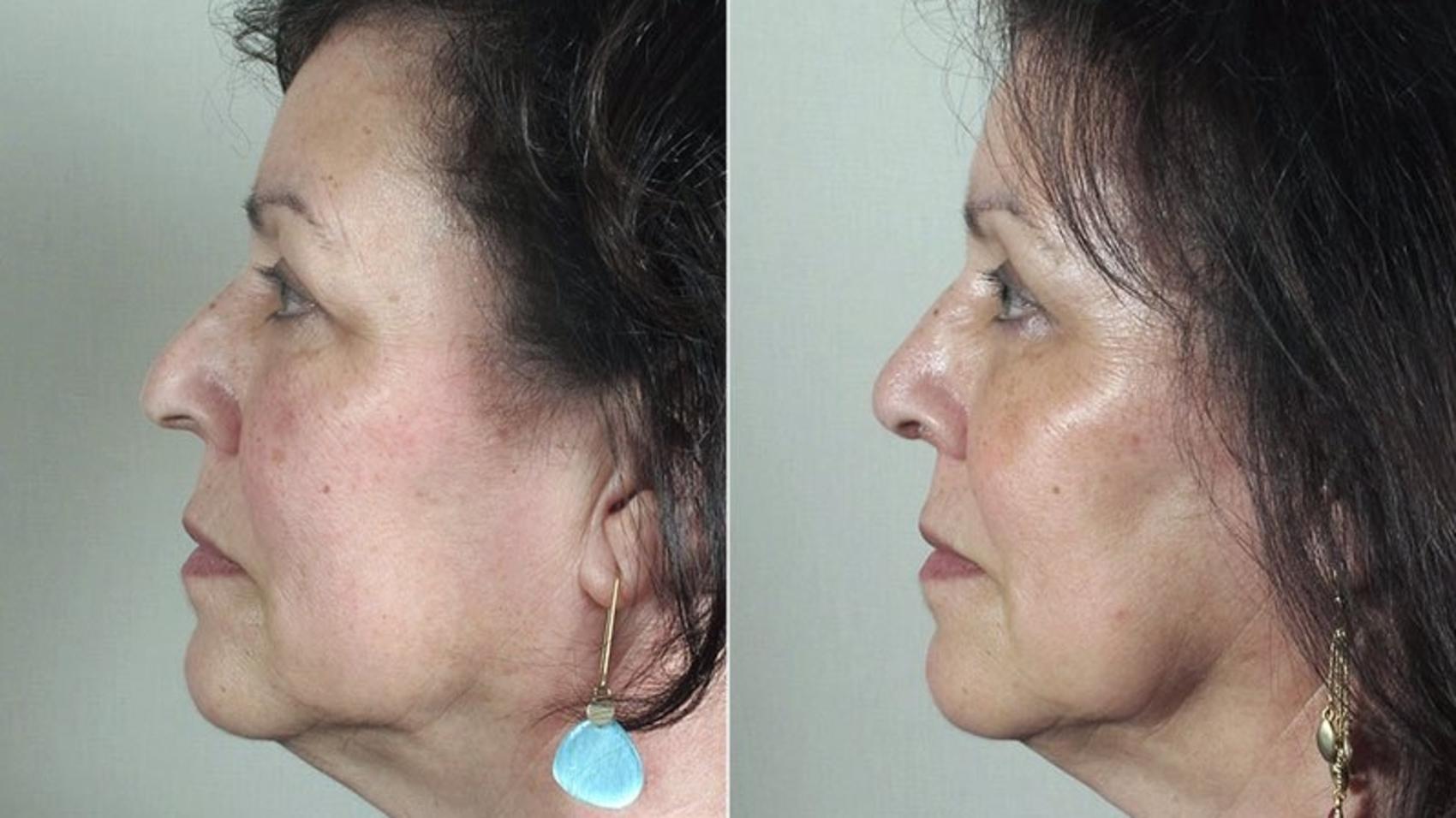 Rhinoplasty Case 174 Before & After View #2 | Paramus, New Jersey | Parker Center for Plastic Surgery