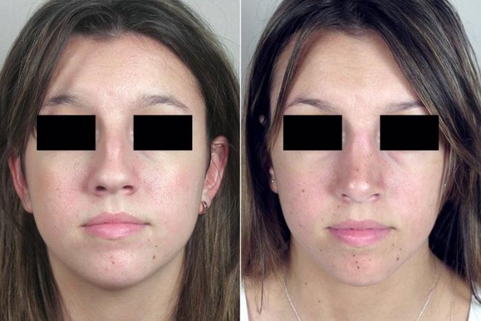 Rhinoplasty Case 175 Before & After View #1 | Paramus, New Jersey | Parker Center for Plastic Surgery