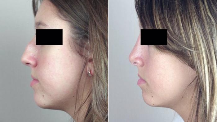 Rhinoplasty Case 175 Before & After View #2 | Paramus, New Jersey | Parker Center for Plastic Surgery