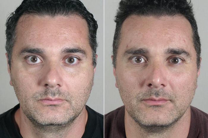 Rhinoplasty Case 176 Before & After View #1 | Paramus, New Jersey | Parker Center for Plastic Surgery