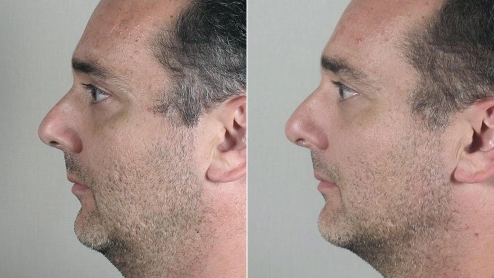 Rhinoplasty Case 176 Before & After View #2 | Paramus, New Jersey | Parker Center for Plastic Surgery