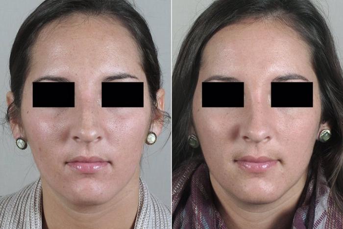 Rhinoplasty Case 177 Before & After View #1 | Paramus, New Jersey | Parker Center for Plastic Surgery