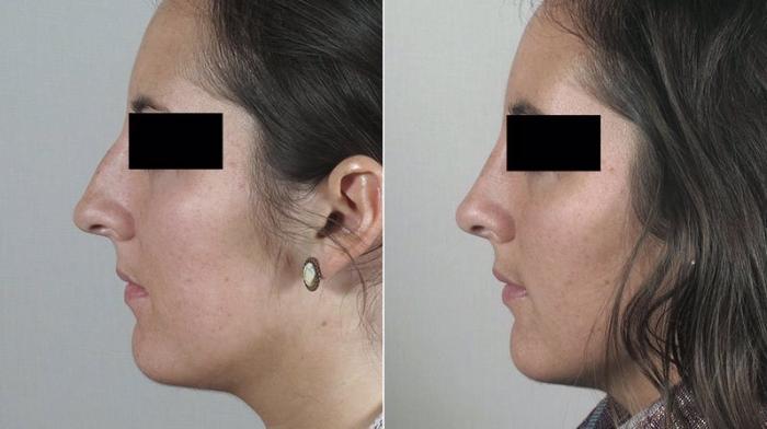 Rhinoplasty Case 177 Before & After View #2 | Paramus, New Jersey | Parker Center for Plastic Surgery
