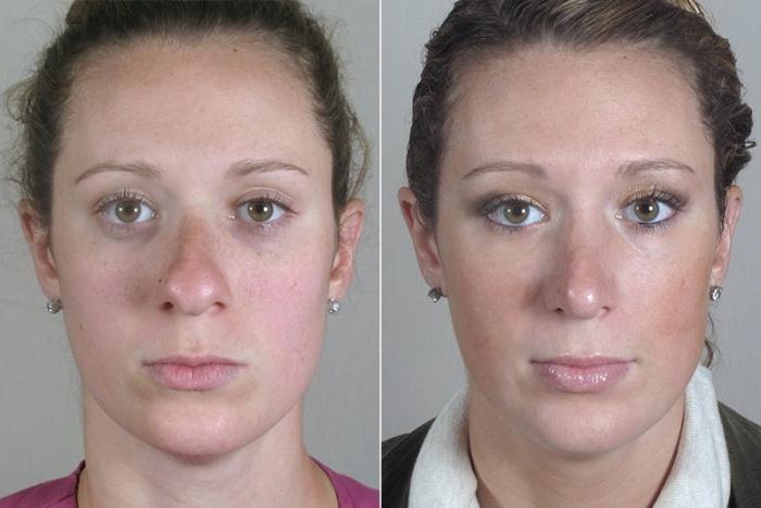 Rhinoplasty Case 178 Before & After View #1 | Paramus, New Jersey | Parker Center for Plastic Surgery