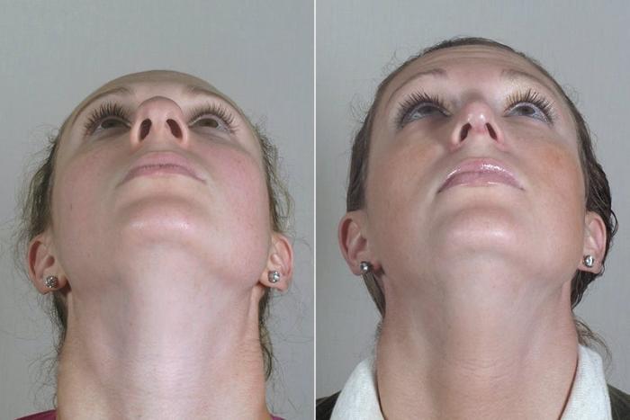 Rhinoplasty Case 178 Before & After View #2 | Paramus, New Jersey | Parker Center for Plastic Surgery