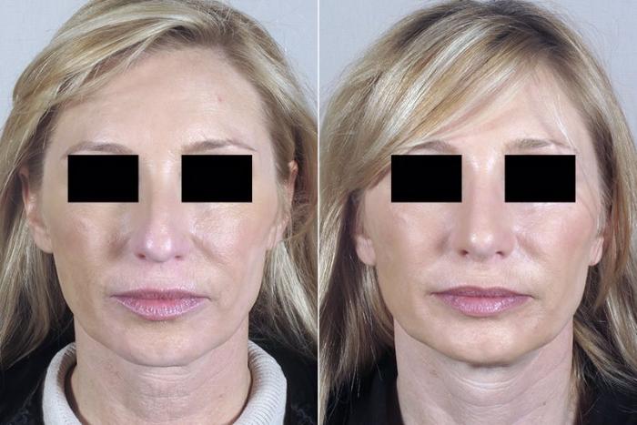Rhinoplasty Case 179 Before & After View #1 | Paramus, New Jersey | Parker Center for Plastic Surgery
