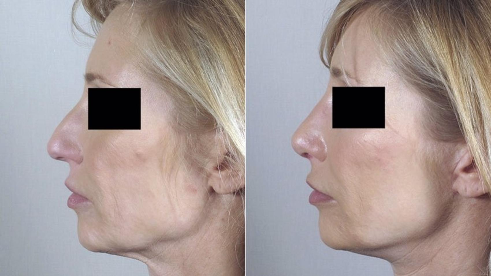 Rhinoplasty Case 179 Before & After View #2 | Paramus, New Jersey | Parker Center for Plastic Surgery