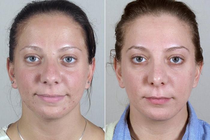 Rhinoplasty Case 180 Before & After View #1 | Paramus, New Jersey | Parker Center for Plastic Surgery