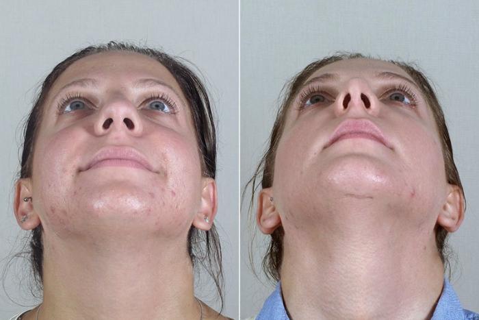 Rhinoplasty Case 180 Before & After View #2 | Paramus, New Jersey | Parker Center for Plastic Surgery