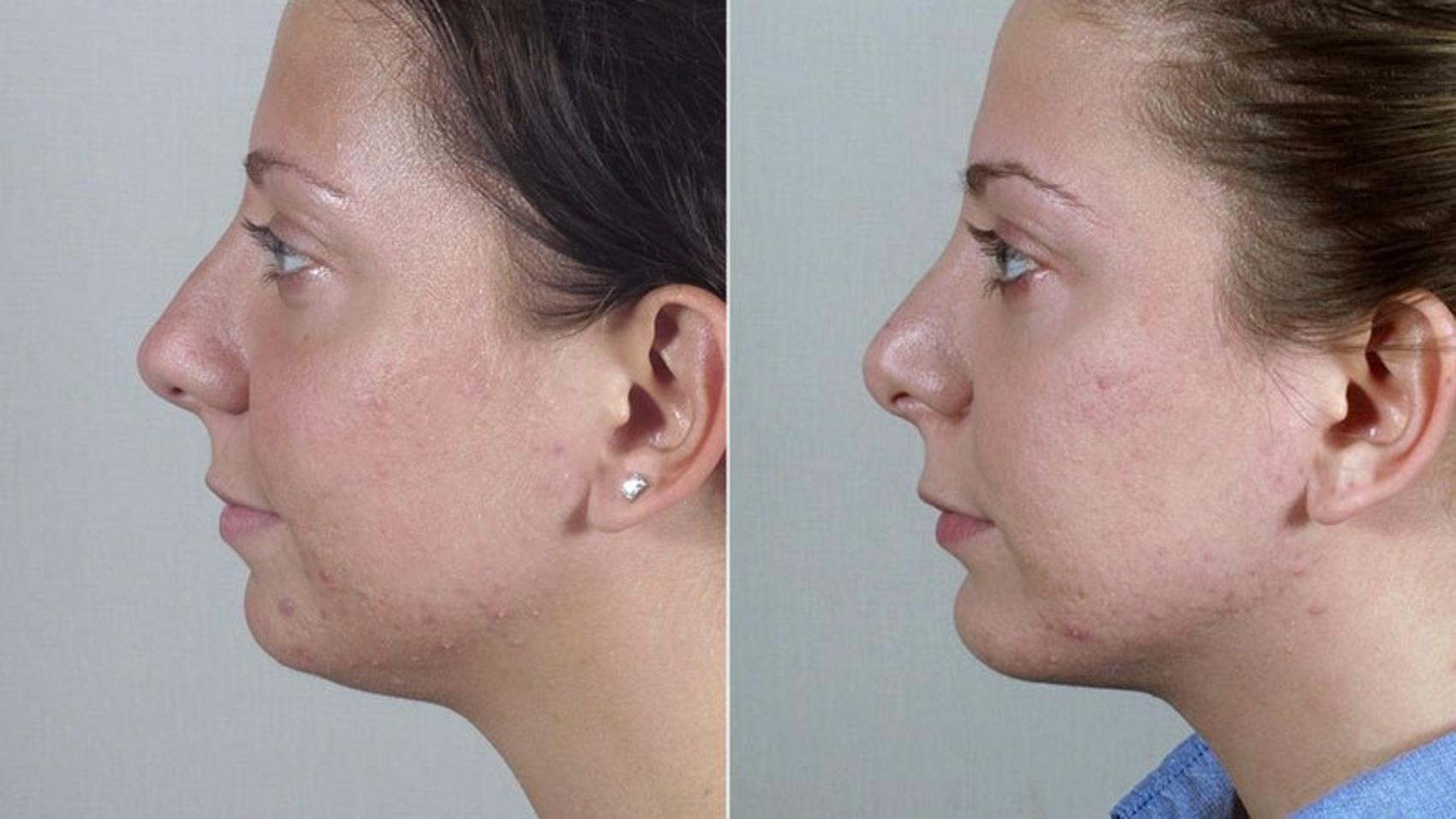 Rhinoplasty Case 180 Before & After View #3 | Paramus, New Jersey | Parker Center for Plastic Surgery