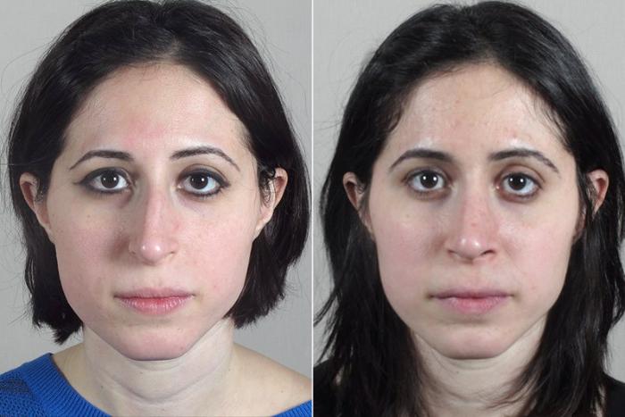 Rhinoplasty Case 181 Before & After View #1 | Paramus, New Jersey | Parker Center for Plastic Surgery