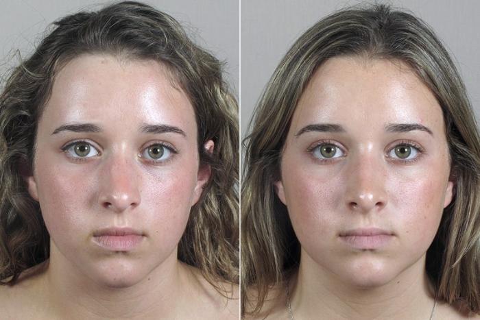 Rhinoplasty Case 182 Before & After View #1 | Paramus, New Jersey | Parker Center for Plastic Surgery