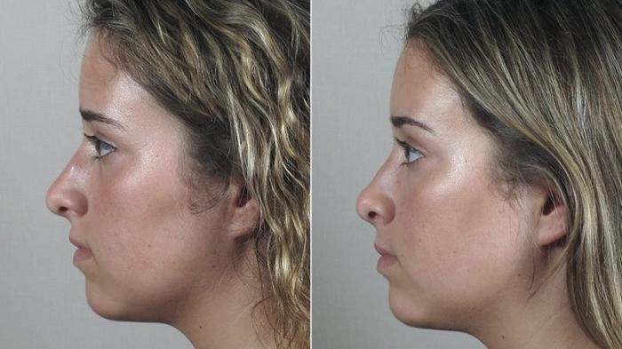 Rhinoplasty Case 182 Before & After View #2 | Paramus, New Jersey | Parker Center for Plastic Surgery