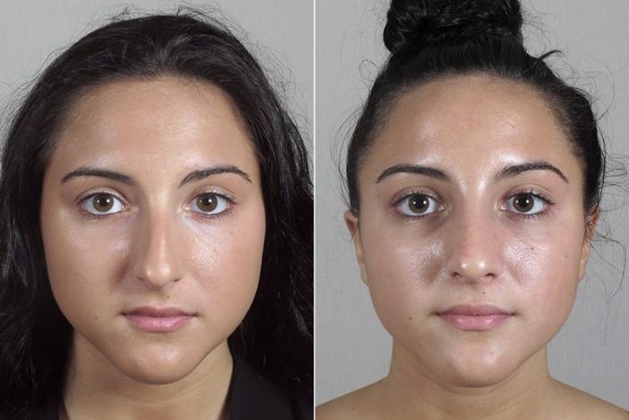 Rhinoplasty Case 183 Before & After View #1 | Paramus, New Jersey | Parker Center for Plastic Surgery