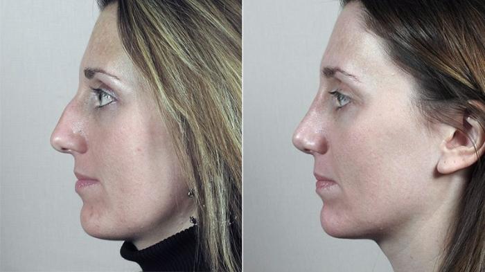 Rhinoplasty Case 185 Before & After View #1 | Paramus, New Jersey | Parker Center for Plastic Surgery