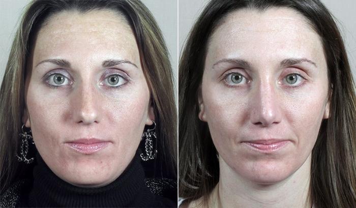 Rhinoplasty Case 185 Before & After View #2 | Paramus, New Jersey | Parker Center for Plastic Surgery