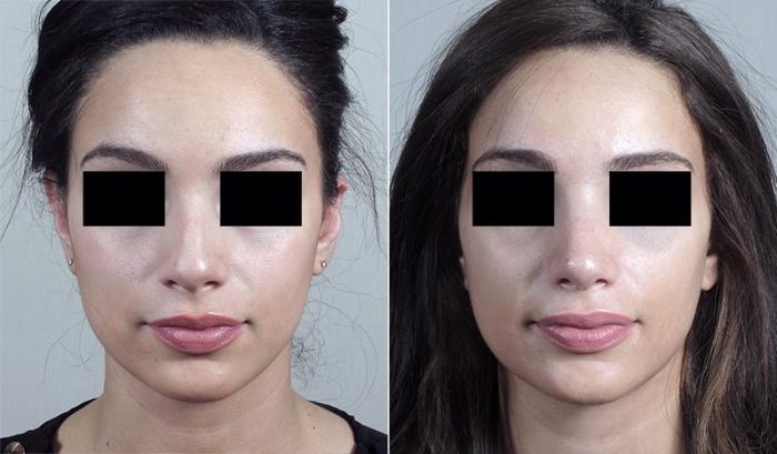 Rhinoplasty Case 186 Before & After View #1 | Paramus, New Jersey | Parker Center for Plastic Surgery