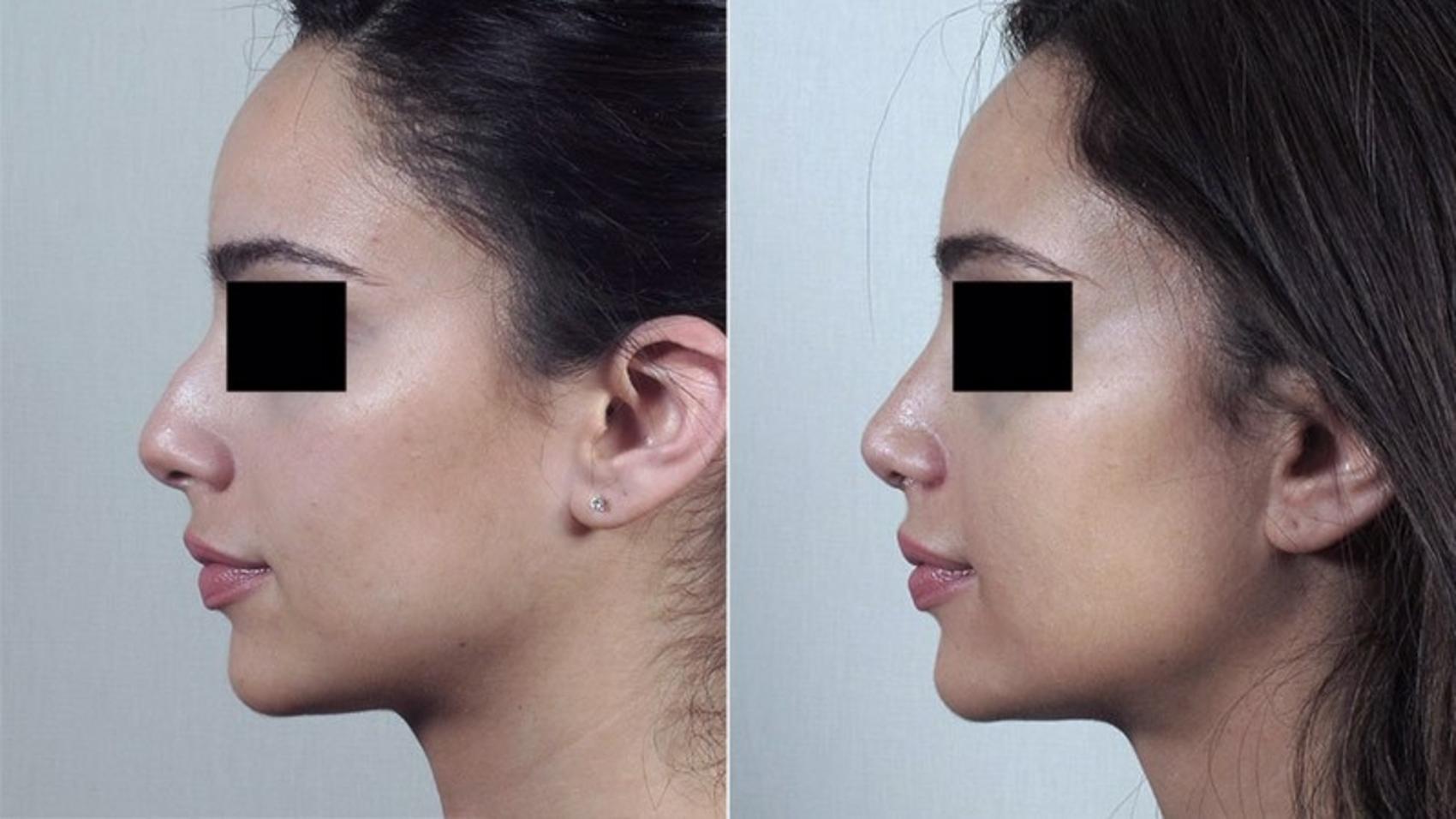 Rhinoplasty Case 186 Before & After View #2 | Paramus, New Jersey | Parker Center for Plastic Surgery