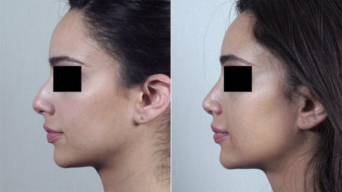 Rhinoplasty Case 186 Before & After View #2 | Paramus, New Jersey | Parker Center for Plastic Surgery